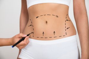 Person Hand Drawing Lines On A Woman's Abdomen As Marks For Abdominal Cellulite Correction